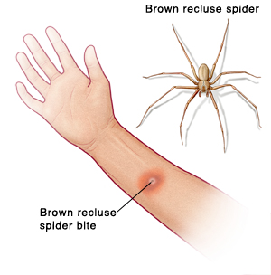 recluse spider