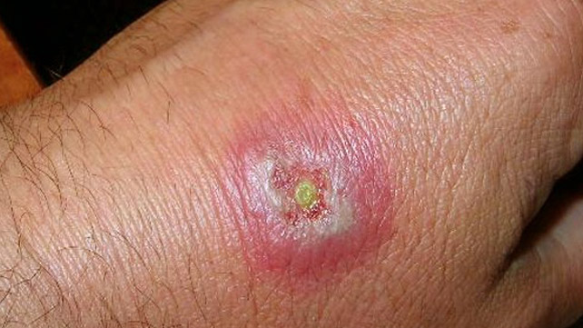 hobo spider bite symptoms