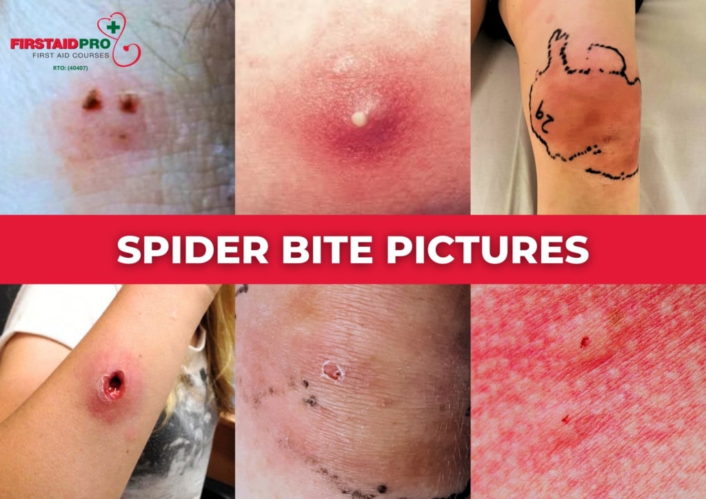 sydney funnel web spider bite wound (1)