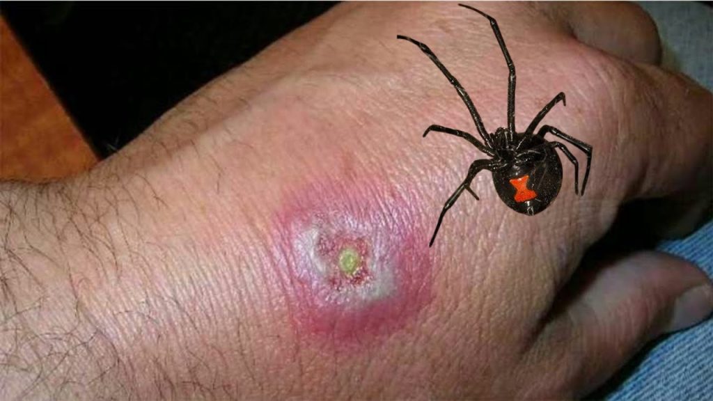 black widow spider bite pictures & symptoms (3)