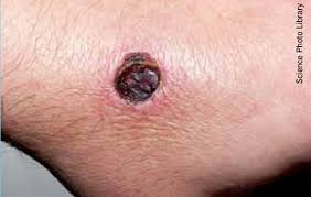 black widow spider bite pictures & symptoms (4)