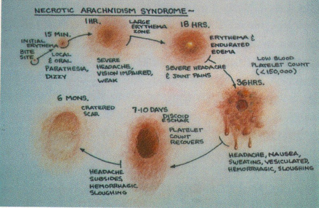 brown recluse spider bite stages pictures