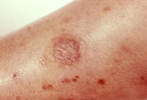 brown recluse spider bite stages pictures (2)